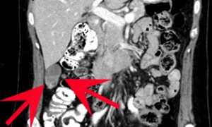 Что Обследует Кт Брюшной Полости и Как Это Происходит