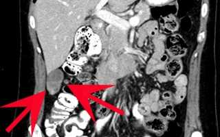 Что Обследует Кт Брюшной Полости и Как Это Происходит