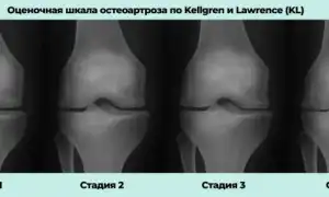 Диагноз Доа: Что Это и Как С ним Жить