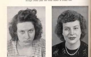 Когда Запретили Лоботомию В Мире и Почему